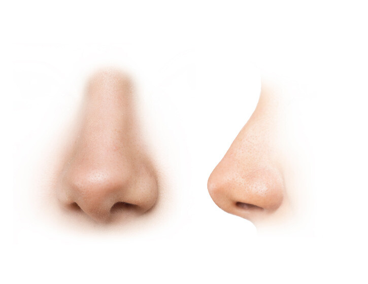 ablauf-rhinoplastik